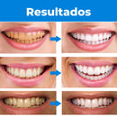 Super White®️ Clareador Dental Profissional PAGUE 1 LEVE 2 + Brinde Exclusivo